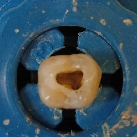 Lo stesso dente con la cavità di accesso aperta al centro della corona