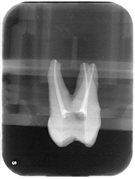 Radiografia di controllo dello stesso dente con i canali radicolari otturati, visibili in bianco