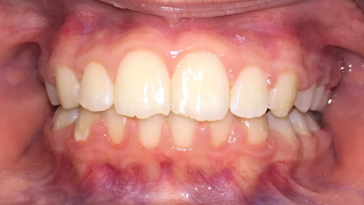 Vista frontale dei denti allineati al termine di un trattamento ortodontico