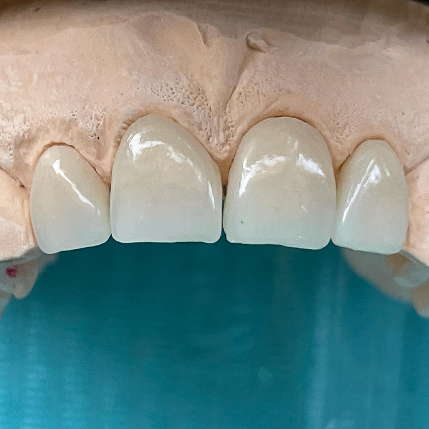 Faccette in ceramica su modello, prima dell'applicazione.
