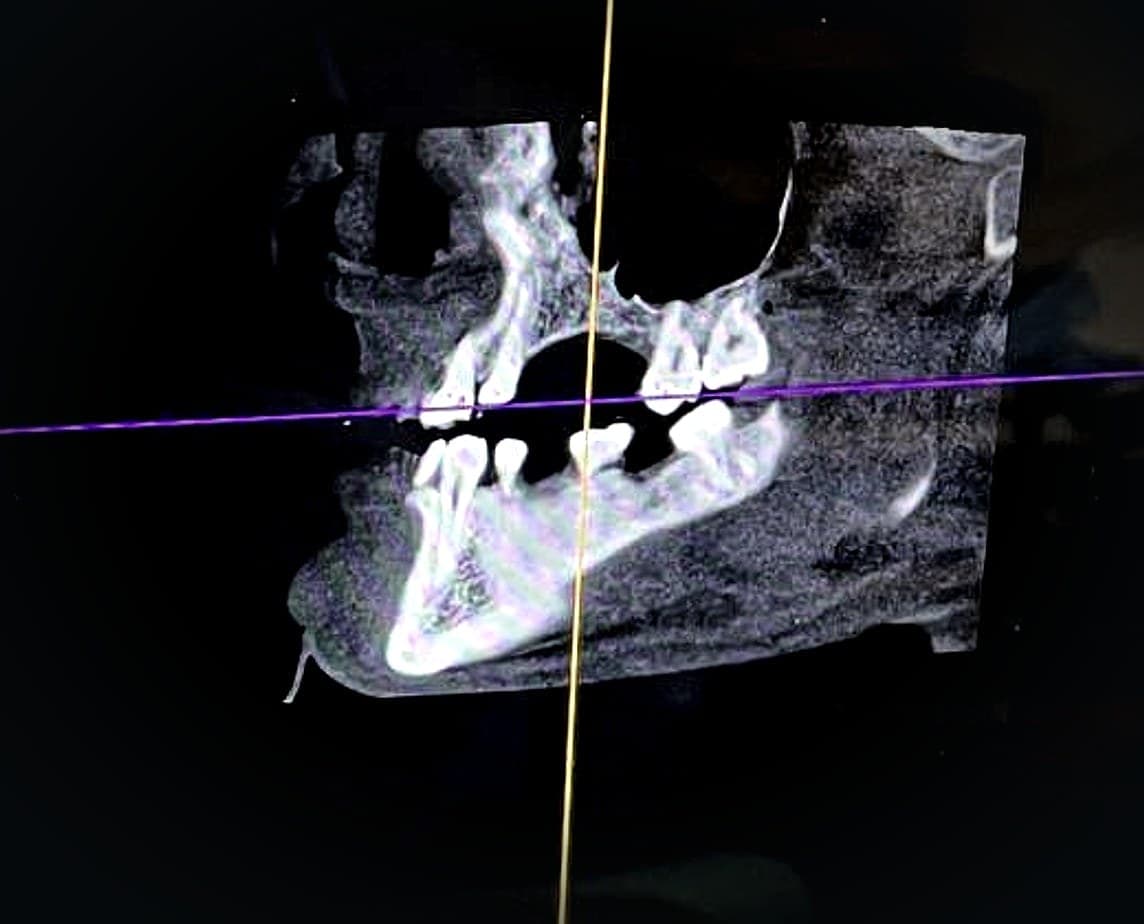 Ricostruzione 3D dell'arcata da una TAC dentale, con gli assi di pianificazione.