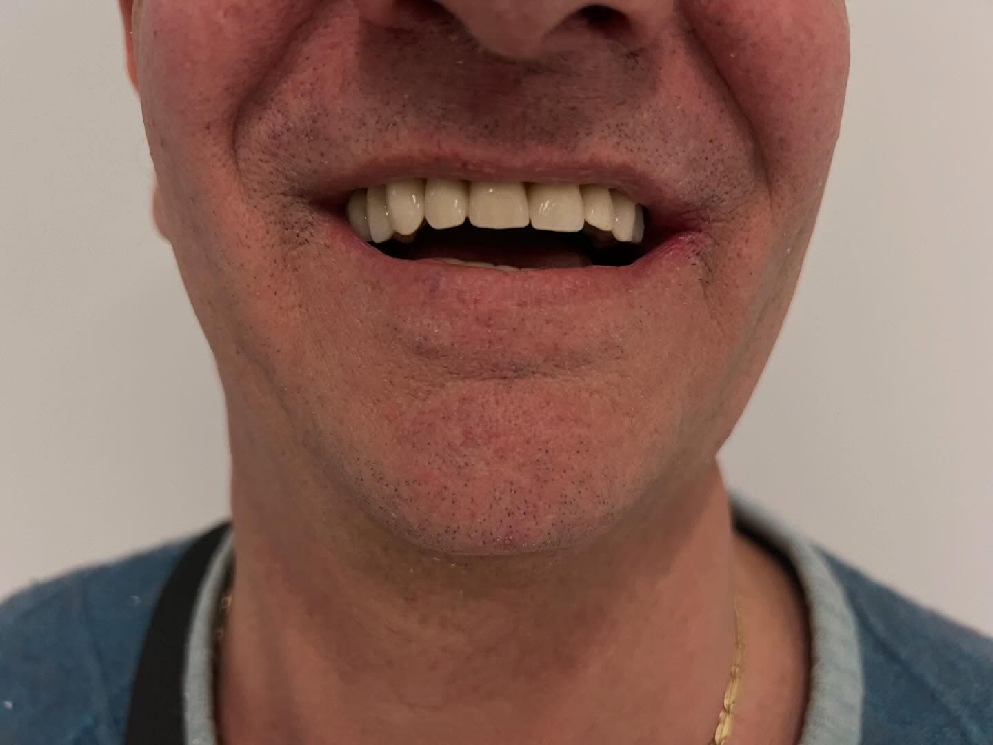 Sorriso dopo il trattamento con corone in ceramica.