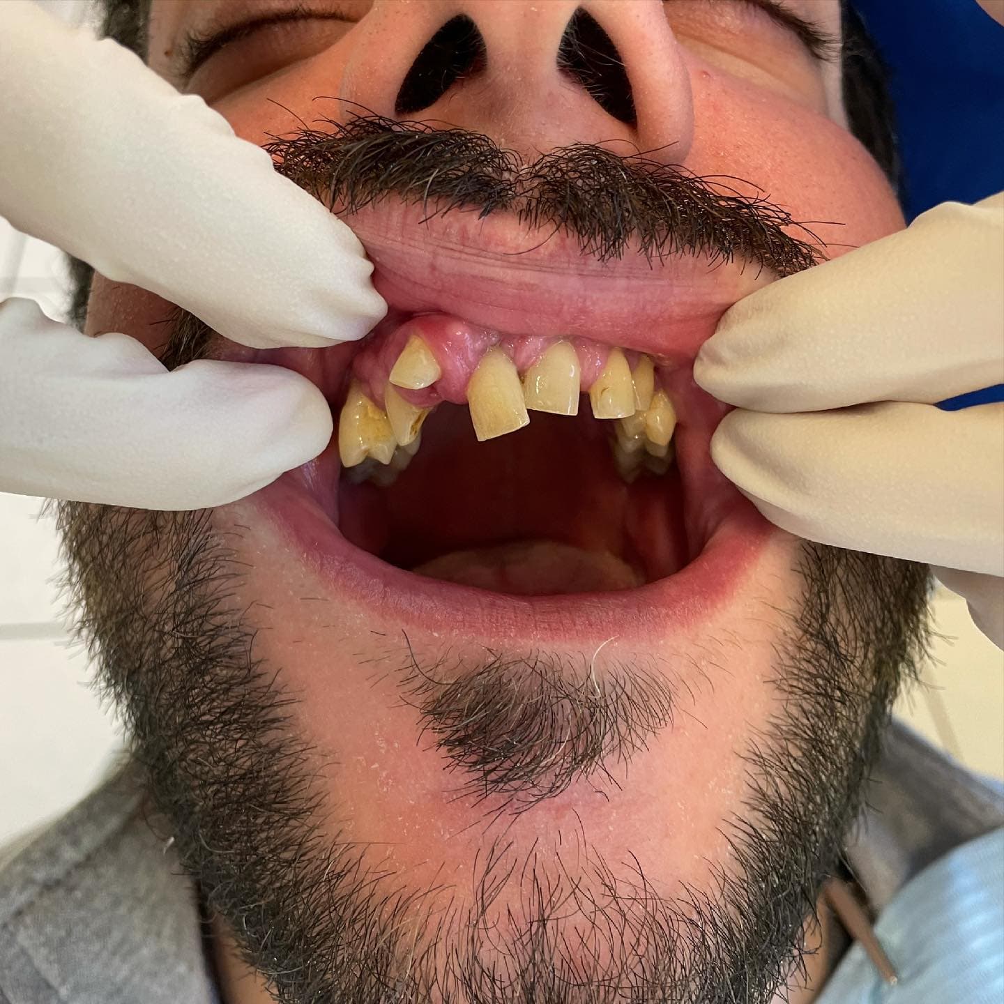 Sorriso del paziente prima del trattamento: denti anteriori compromessi e mancanti.