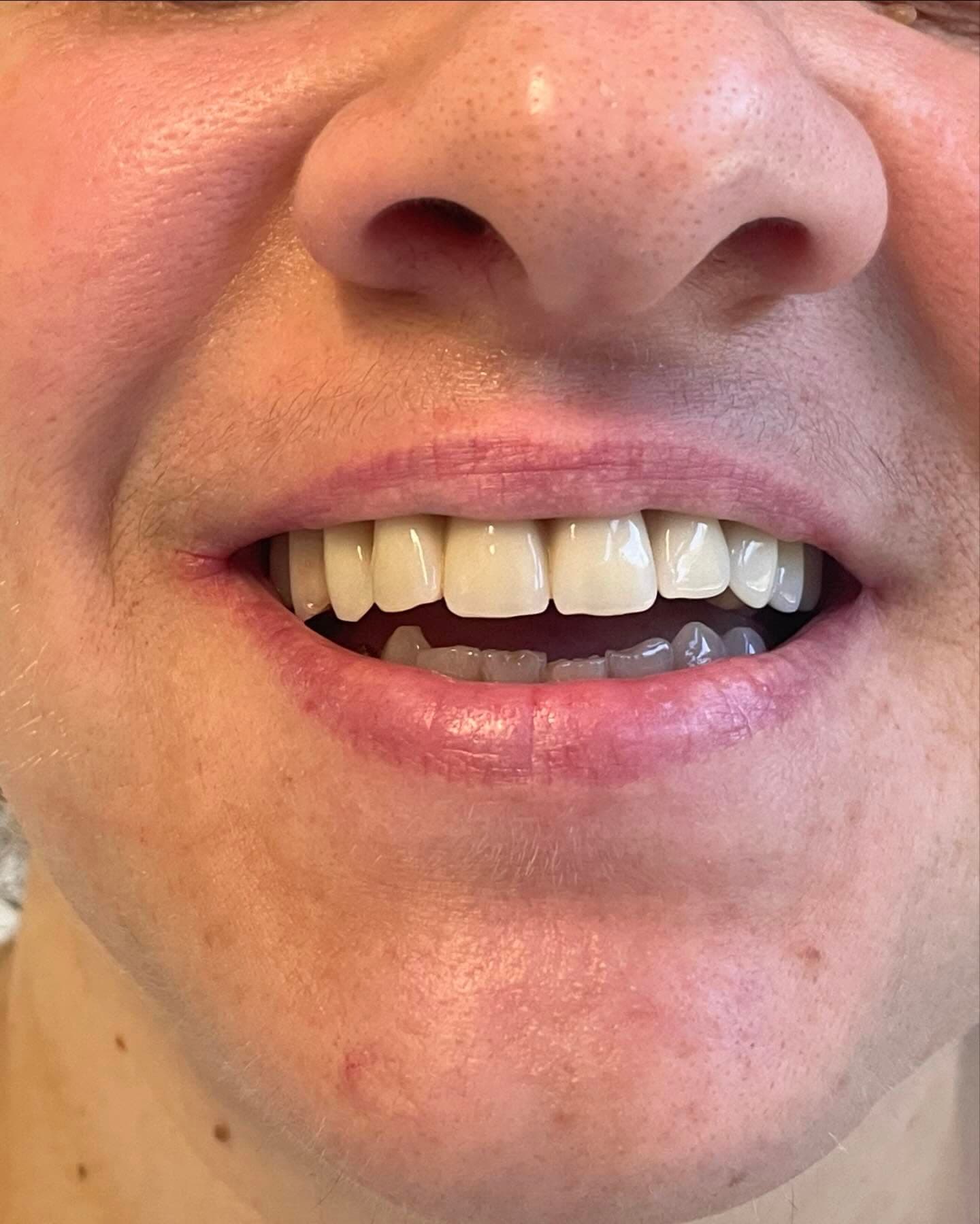 Sorriso dopo un trattamento di estetica dentale con faccette.
